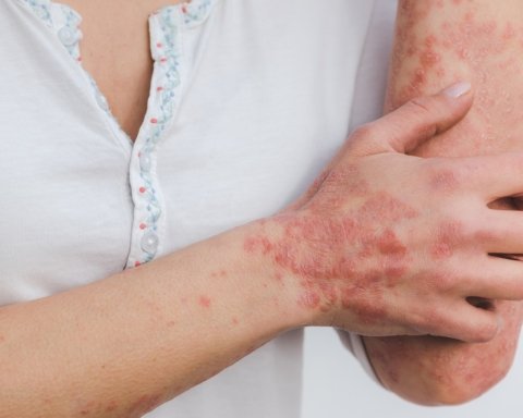 Giornata Mondiale della Psoriasi